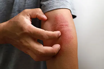 atopic dermatitis eczema