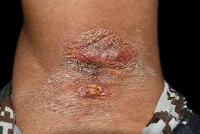 hidradenitis suppurativa
