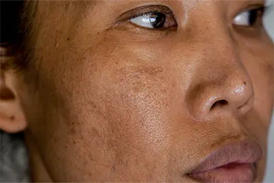 hyperpigmentation melasma