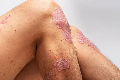 legs with psoriasis patches