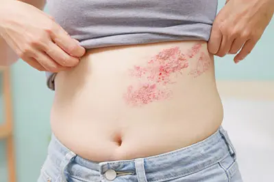 shingles