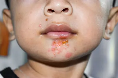 skin infection