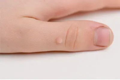 wart on a thumb